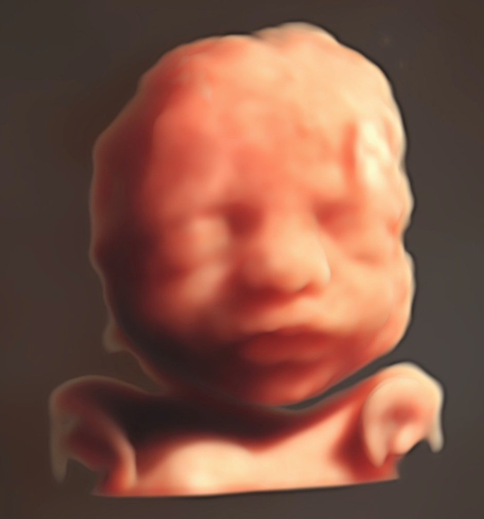 Cebb Echographie 3d 4d Cebb Echographie 3d 4d