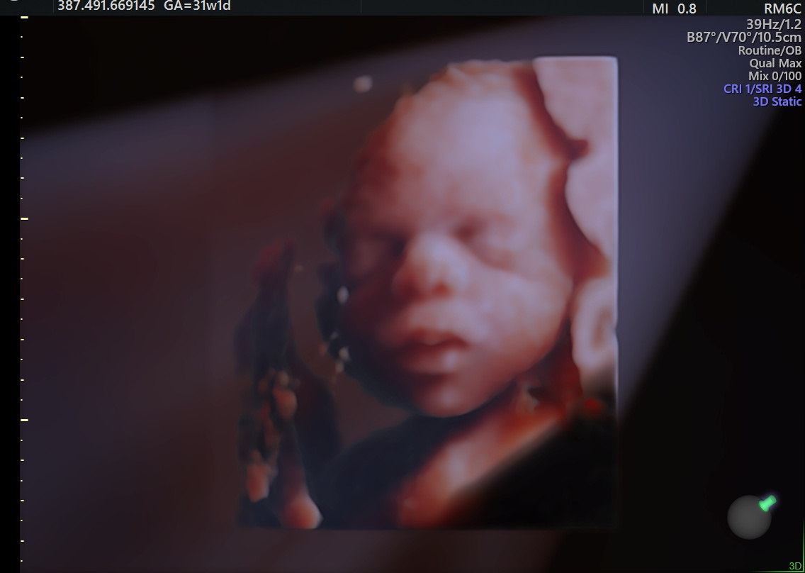 Cebb L Echographie Du Troisieme Trimestre